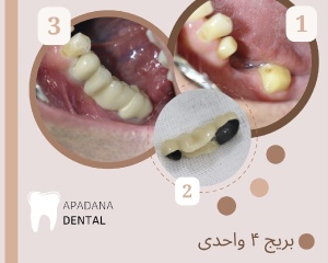 بریج دندان در کلینیک دندنپزشکی آپادانا