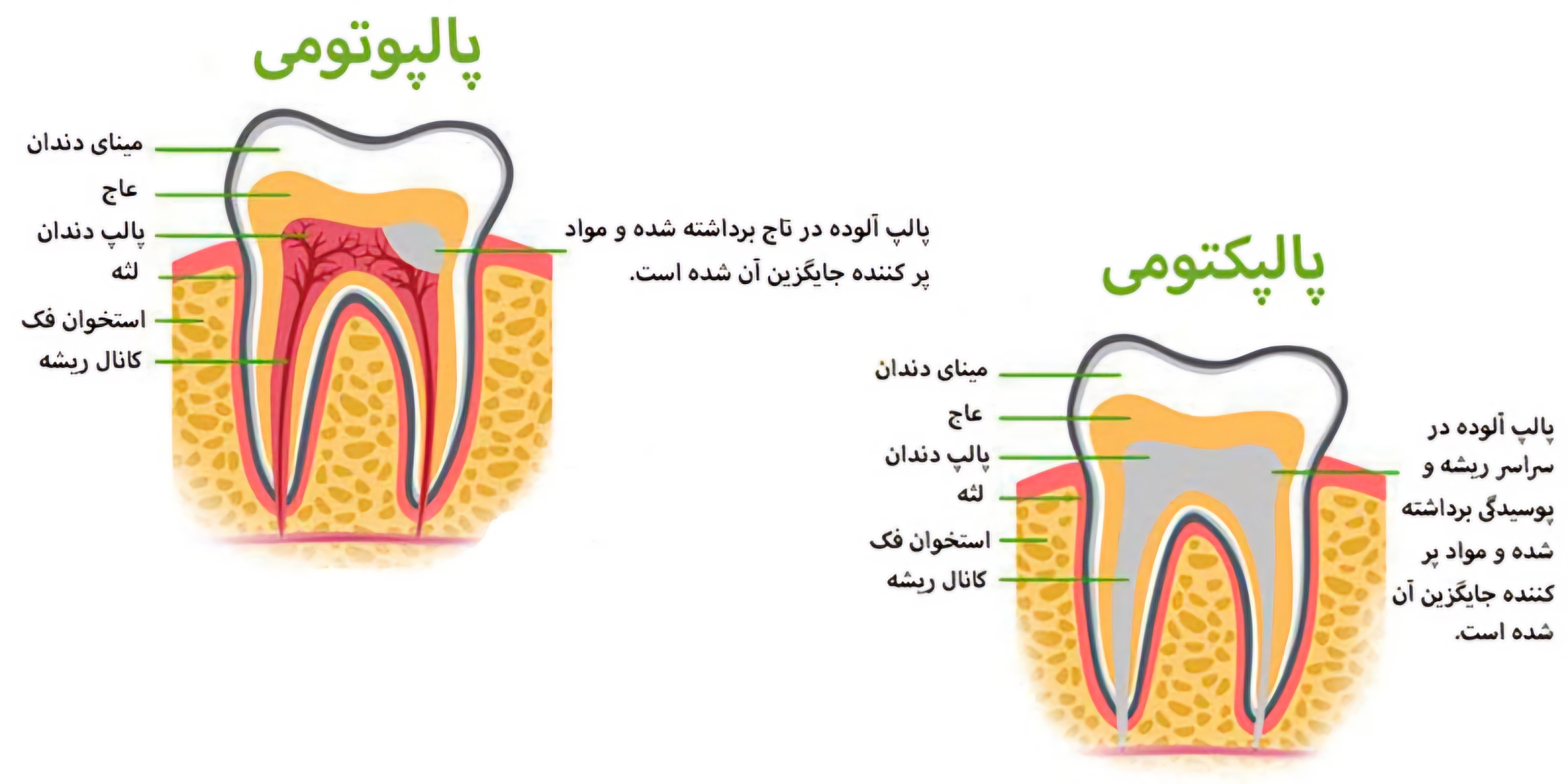 پالپکتومی در درمانگاه دندانپزشکی آپادانا