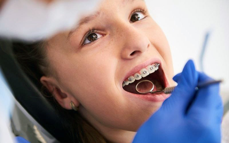 ارتودنسی ثابت در کلینیک دندانپزشکی آپادانا رشت