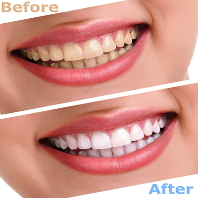 ترمیم  و زیبایی دندان در درمانگاه دندانپزشکی آپادانا
