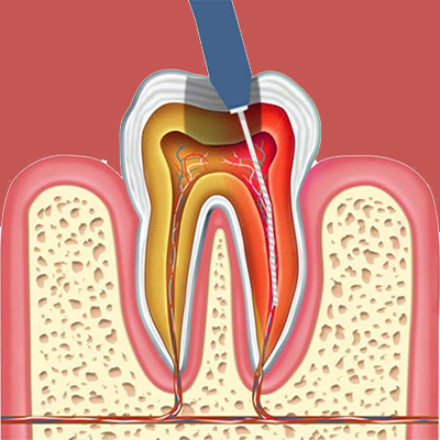 پالپکتومی در درمانگاه دندانپزشکی آپادانا