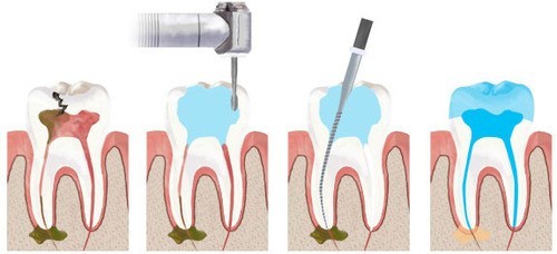 عکس فایل در ریشه- درمانگاه دندانپزشکی آپادانا