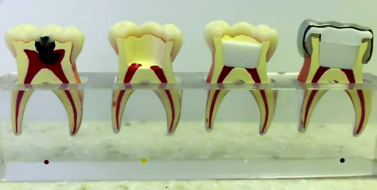 فضای نگهدار دندان در درمانگاه دندانپزشکی آپادانا