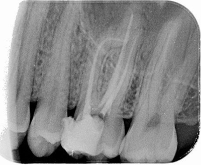 عکس رادیوگرافی اندو- درمانگاه دندانپزشکی آپادانا