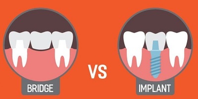تفاوت بریج با ایمپلنت درمانگاه دندانپزشکی آپادانا