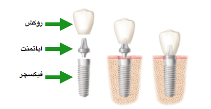 عکس عناصر ایمپلنت-درمانگاه دندانپزشکی آپادانا