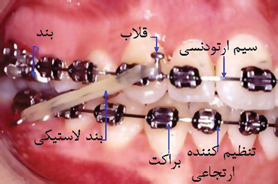 عکس ارتودنسی-درمانگاه دندانپزشکی آپادانا