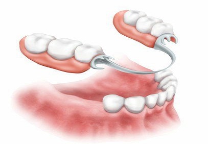 عکس پروتز  متحرک پارسیل فلزی-درمانگاه دندانپزشکی آپادانا