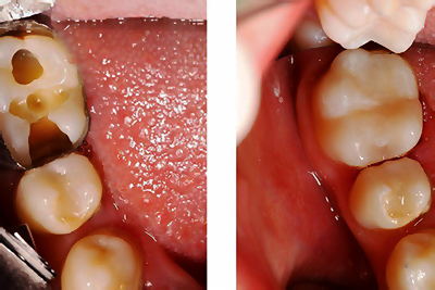 عکس  ترمیم با مواد همرنگ دندان-درمانگاه دندانپزشکی آپادانا