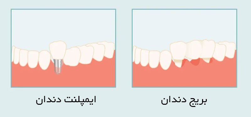 تفاوت بریج با ایمپلنت درمانگاه دندانپزشکی آپادانا