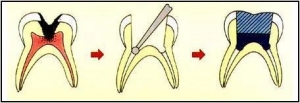 پالپوتومی (pulpotomy) چیست؟