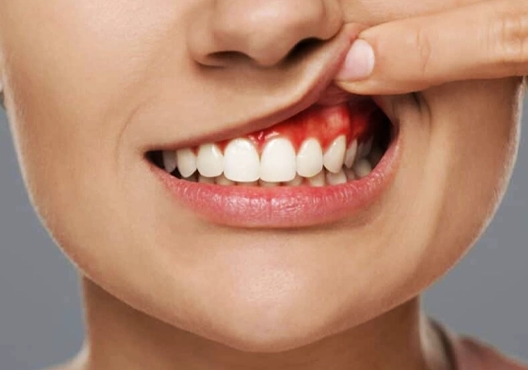 Gum disease