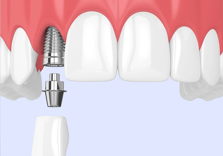 How to implant teeth