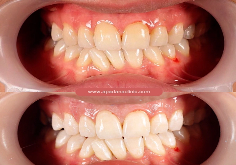 Teeth whitening