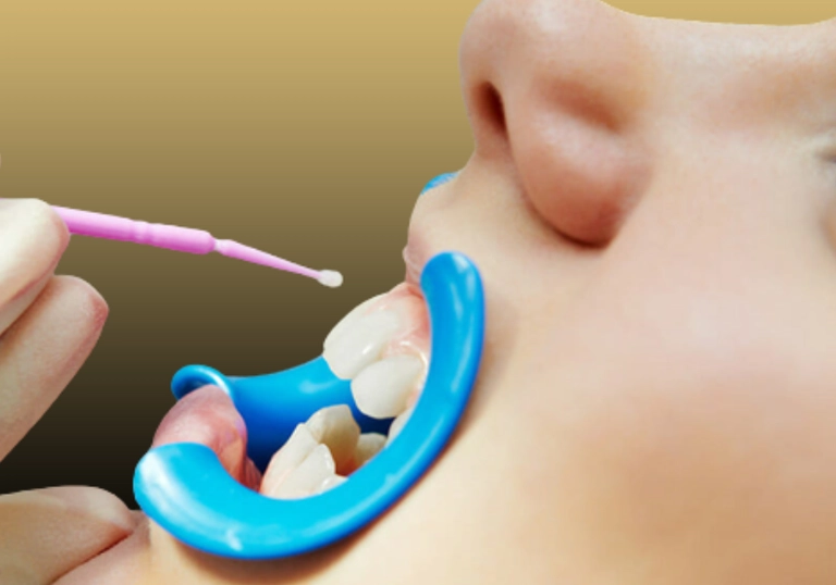 What is fluoride therapy1